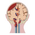 Brain hematoma with tissue distortion.